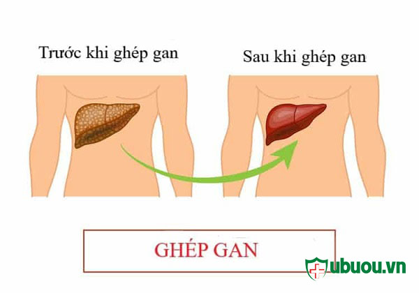 Ghép gan là biện pháp điều trị bệnh hiệu quả nhất