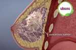 Bệnh u xơ tuyến vú gây ra các triệu chứng gì?