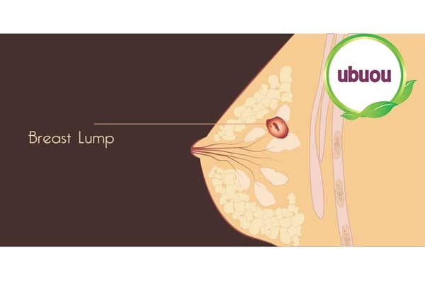 Hình ảnh minh họa u xơ trong tuyến vú