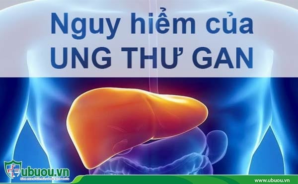 Ung thư gan ở giai đoạn 3 đã ở mức nguy hiểm