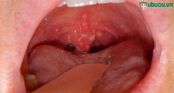 Có cách điều trị ung thư vòm họng giai đoạn 3 không?
