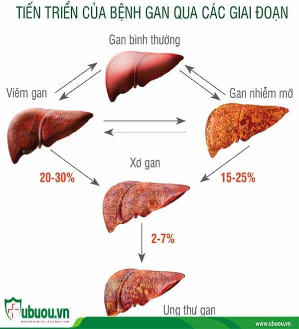 Ung thư gan có chữa được không? Hãy theo dõi từng giai đoạn của bệnh lý Ung thư gan có chữa được không? Hãy theo dõi từng giai đoạn của bệnh lý