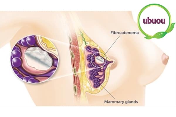 Hình ảnh minh họa khối u xơ xuất hiện trong tuyến vú phụ nữ