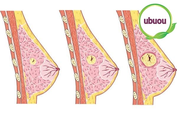Do mất cân bằng nội tiết hình thành khối u xơ trong tuyến vú