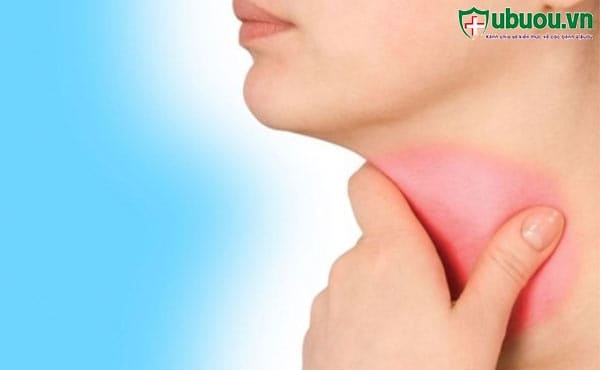 Khối u ở cổ - Biểu hiện của bệnh ung thư vòm họng giai đoạn cuối