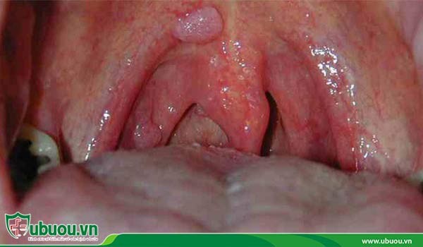 Kích thước khối u ung thư vòm họng giai đoạn đầu khoảng 1cm