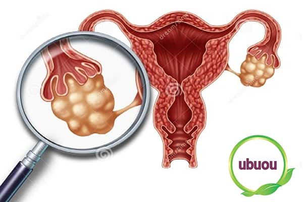 U nang buồng trứng là bệnh thường gặp ở chị em phụ nữ