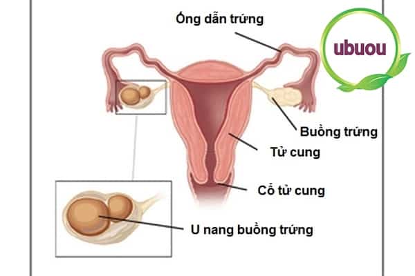 Hình ảnh minh họa buồng trứng có u nang