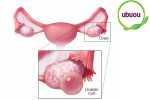 Tìm hiểu về u nang buồng trứng trái