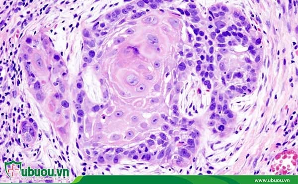 Ung thư biểu mô tế bào gan và điều trị ung thư biểu mô tế bào gan