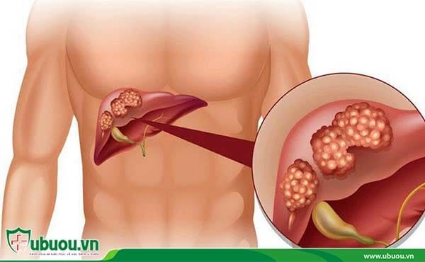 Ung thư gan có chữa được không khi đã ở giai đoạn cuối? Ung thư gan có chữa được không?