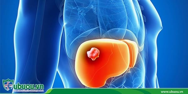 Ung thư gan giai đoạn 2 khối u bắt đầu xâm lấn đến các mô xung quanh Ung thư gan giai đoạn 2 khối u bắt đầu xâm lấn đến các mô xung quanh