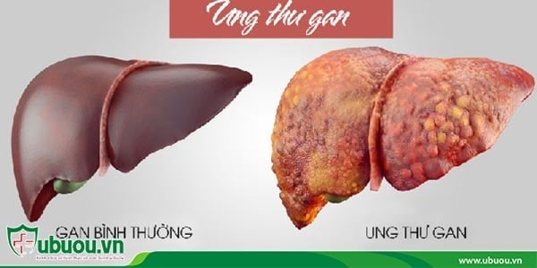 Ung thư gan giai đoạn cuối sống được bao lâu?