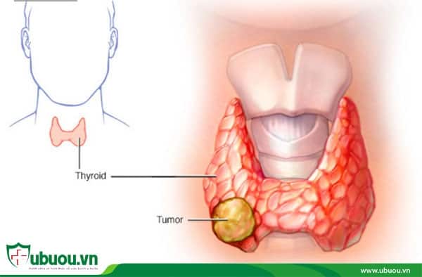 Ung thư tuyến giáp thể không biệt hóa