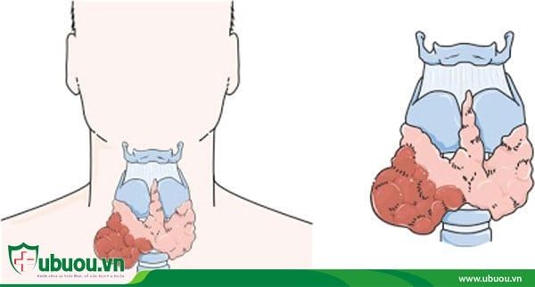 Ung thư tuyến giáp thể nang