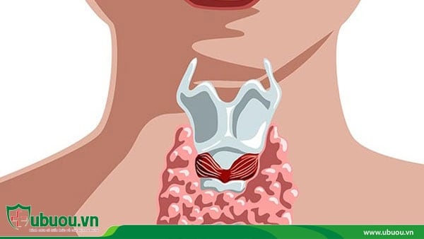 Ung thư tuyến giáp di căn hạch thể nhú