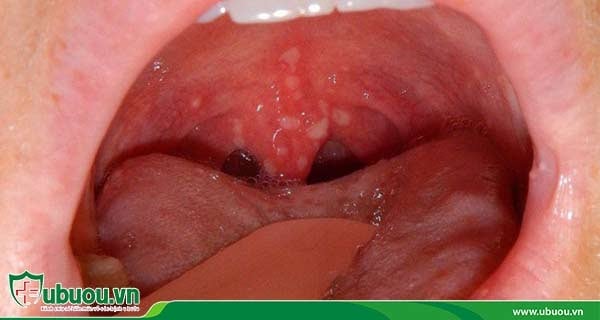 Giai đoạn 3, ung thư vòm họng có những khối u rõ rệt hơn