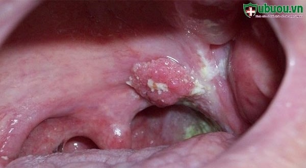 Hình ảnh ung thư vòm họng lớn phát triển ở vòm họng