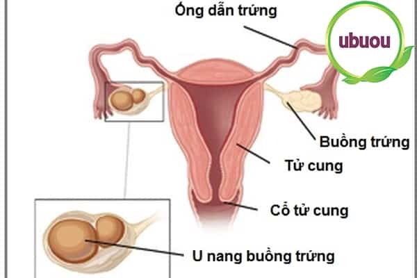 Hình ảnh minh họa u nang buồng trứng bên trái