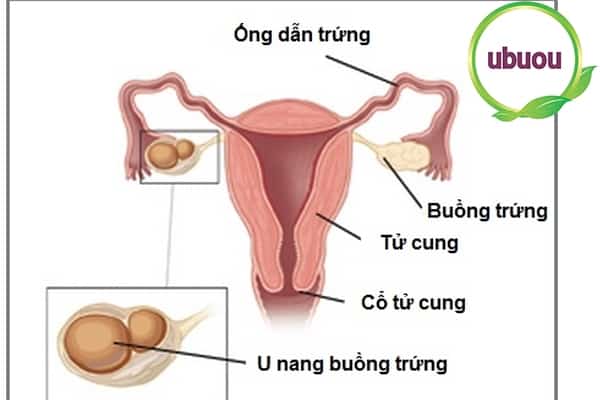 U nang nằm bên trái trong buồng trứng