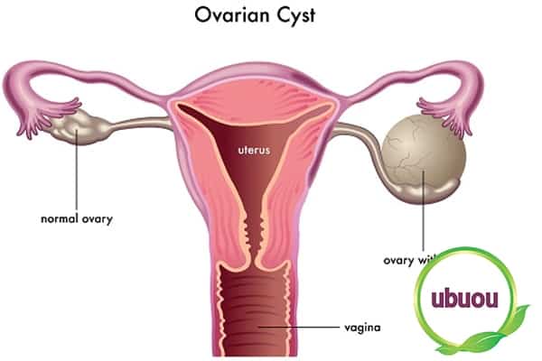 Hình ảnh minh họa u nang hình thành trong buồng trứng phải