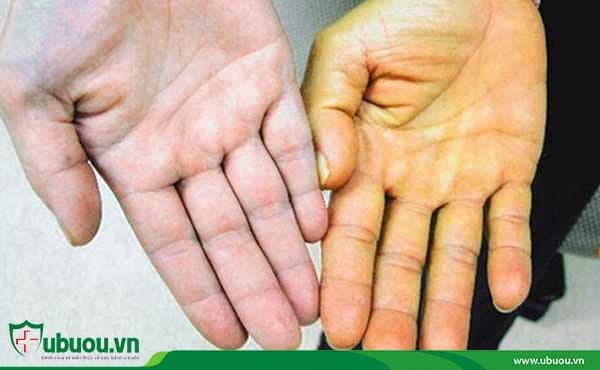 Vàng da là một trong những biểu hiện dễ thấy khi mắc bệnh ung thư gan Vàng da - Biểu hiện dễ thấy khi mắc bệnh ung thư gan