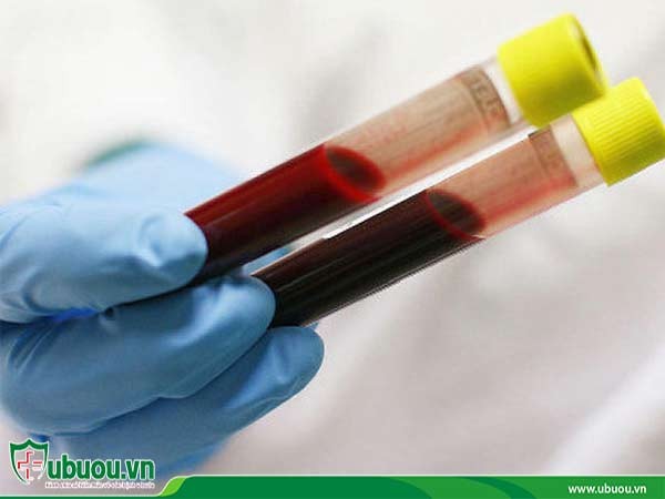 Xét nghiệm máu giúp chẩn đoán ung thư gan