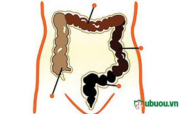 bị táo bón thường xuyên là dấu hiệu nhận biết bệnh u xơ tử cung
