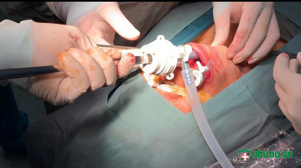 Phẫu phuật ung thư tuyến giáp qua miệng
