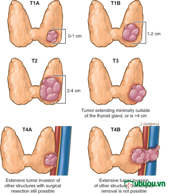 biểu hiện của u tuyến giáp thùy trái qua các thời kỳ