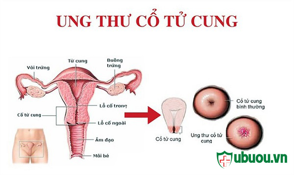 hình ảnh minh họa cho người bị ung thư cổ tử cung