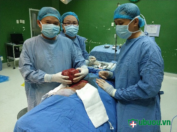 Bác sỹ phẫu thuật một khối u basedow nặng gần 2kg