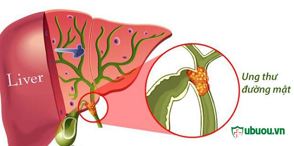 Ung thư đường mật ảnh hưởng đến gan