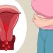 10 dấu hiệu ung thư cổ tử cung mà bạn nên nắm vững