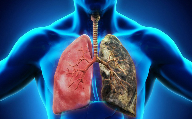 Tầm soát ung thư phổi như thế nào? Địa chỉ nào uy tín?