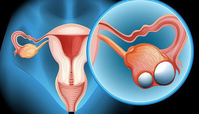 Ung thư buồng trứng là gì? Nguyên nhân, triệu chứng và cách điều trị