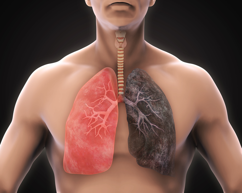 Ung thư phổi sống được bao lâu?