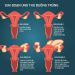 Tìm hiểu về các giai đoạn ung thư buồng trứng