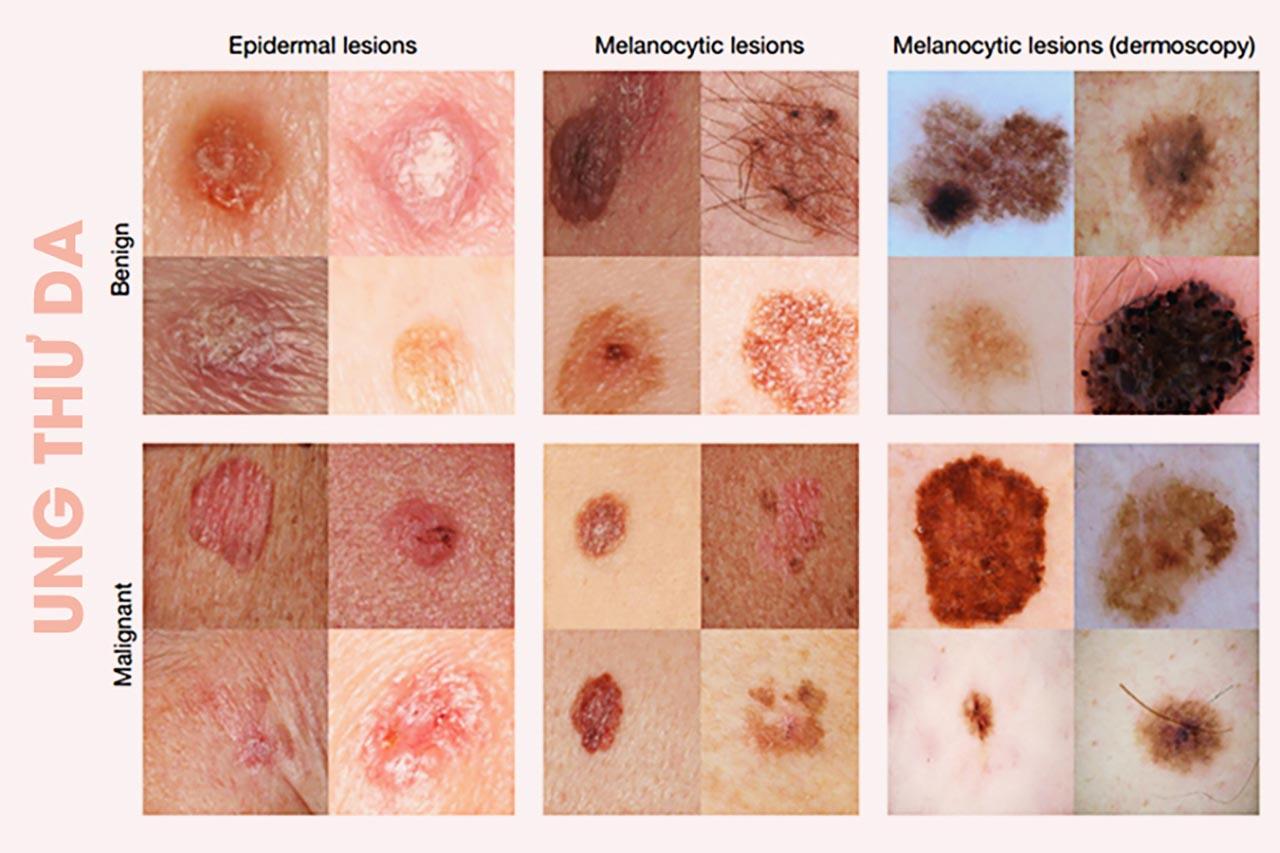 8 biểu hiện ung thư da dễ nhận biết để điều trị sớm