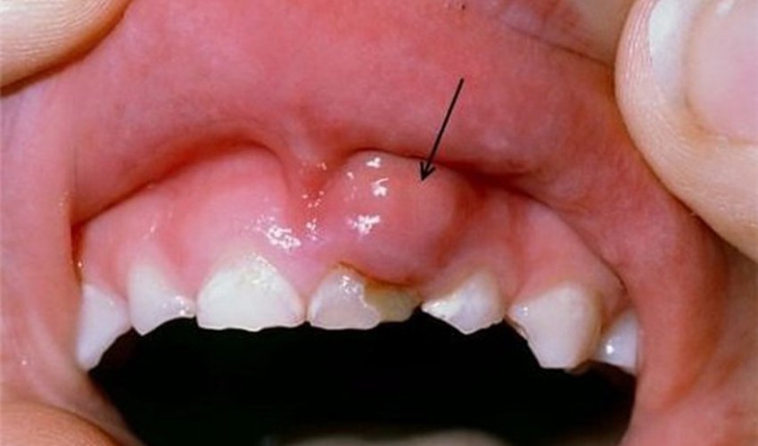 Ung thư răng là gì? Dấu hiệu và những cảnh báo nguy hiểm