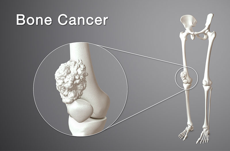 Tìm hiểu bài thuốc chữa ung thư xương bằng thuốc nam
