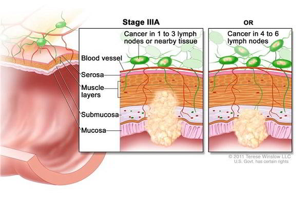 Biểu hiện của các giai đoạn ung thư dạ dày, nguyên nhân gây bệnh