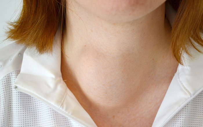 Những dấu hiệu u bướu cổ và cách phòng tránh u bướu cổ đơn giản