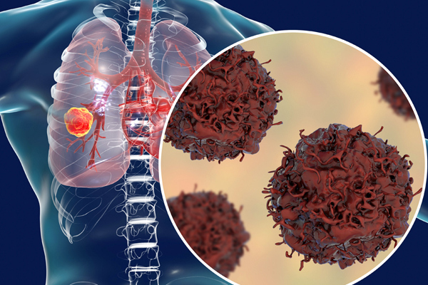 Tìm hiểu về những biểu hiện ung thư phổi