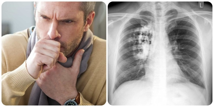Các triệu chứng ung thư phổi có dễ phát hiện không?