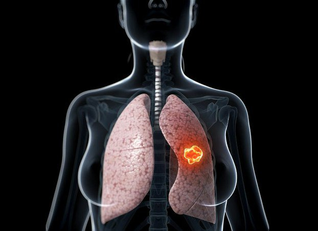 Bệnh ung thư phổi giai đoạn đầu sống được bao lâu?